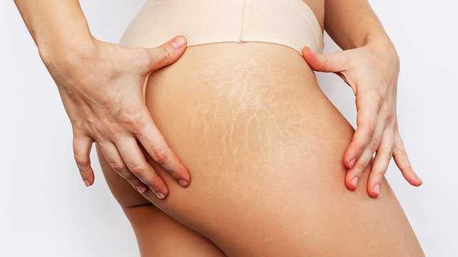 7 tips för att förebygga bristningar